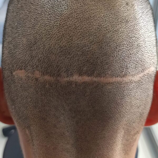 Head scar before treatment