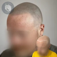 Scalp Micropigmentation before and after
