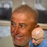Scalp Micropigmentation before and after