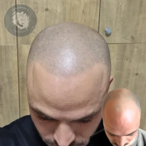 Scalp Micropigmentation before and after
