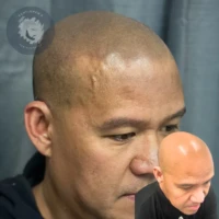 Scalp Micropigmentation before and after