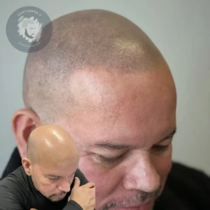Scalp Micropigmentation before and after