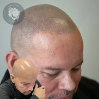 Scalp Micropigmentation before and after