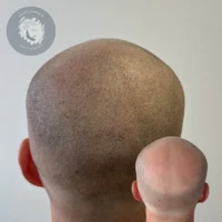 Scalp Micropigmentation before and after