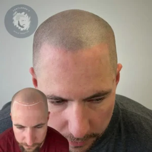 Scalp Micropigmentation before and after