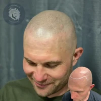 Scalp Micropigmentation before and after