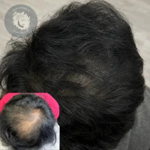Scalp Micropigmentation before and after