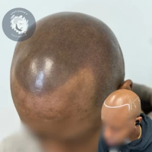 Scalp Micropigmentation before and after