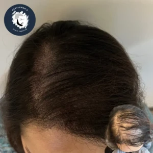 Female Scalp Micropigmentation before and after