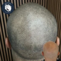Scalp Micropigmentation before and after