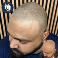 Scalp Micropigmentation before and after