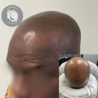 Scalp Micropigmentation before and after